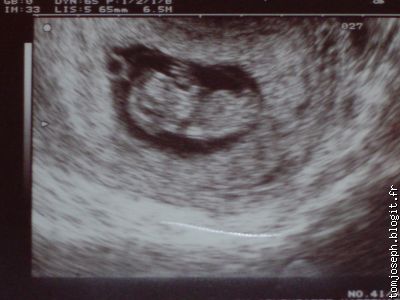 c bien moi à 10 semaines de grossesse  le 21 octobre 2005